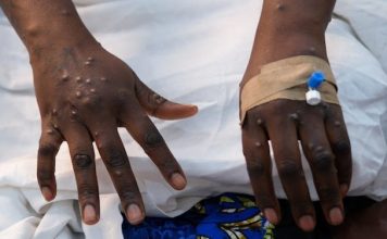 GHS to intensify Mpox sensitisation campaigns as cases hit 302
