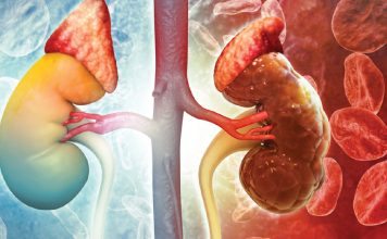 About 4 million Ghanaians living with kidney disease – Specialist reveals
